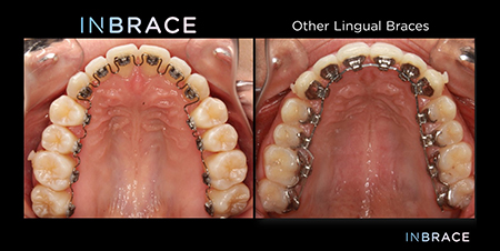 Inbrace