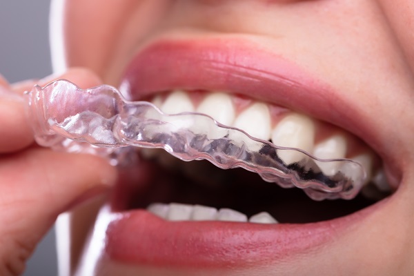 Reasons To Consider SureSmile Clear Aligners For Teeth Straightening