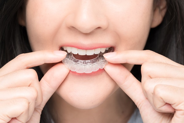 The Benefits Of Clear Braces