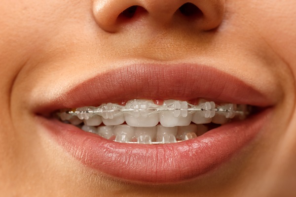 Clear Braces For Aesthetic Results