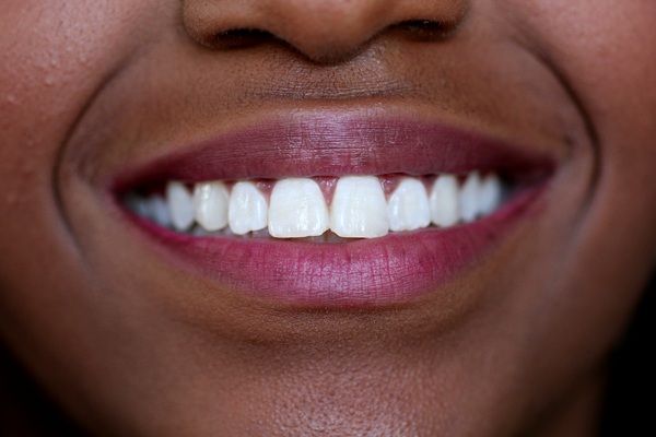 Which Teeth Straightening Option Is Right For You?